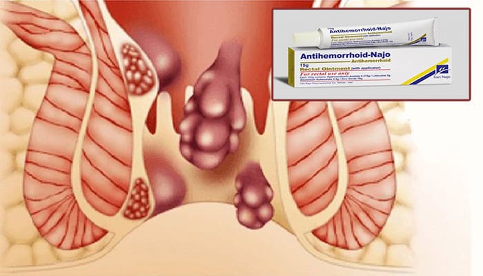 Side effects of anti-hemorrhoid ointment
