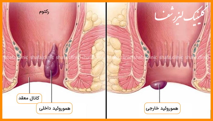 نمای آناتومیک تفاوت هموروئید داخلی و خارجی در کانال مقعد و رکتوم