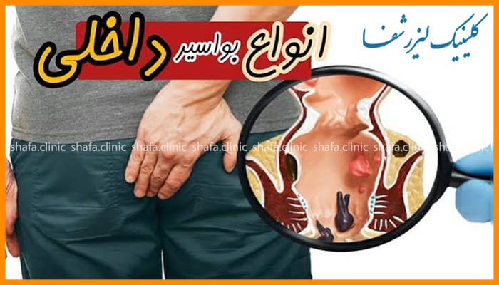 "تصویر آموزشی با بزرگنمایی از انواع بواسیر داخلی و روشهای تشخیص و درمان آن