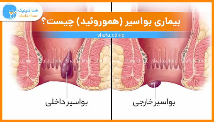 هموروئید یا بواسیر چیست