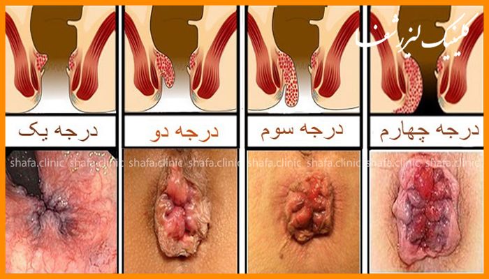 چه بیماری هایی می توانند باعث علائم مقعدی شوند؟