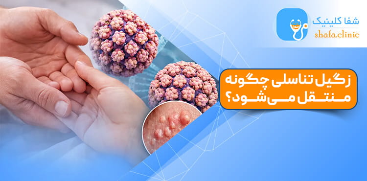 زگیل تناسلی چگونه منتقل میشود