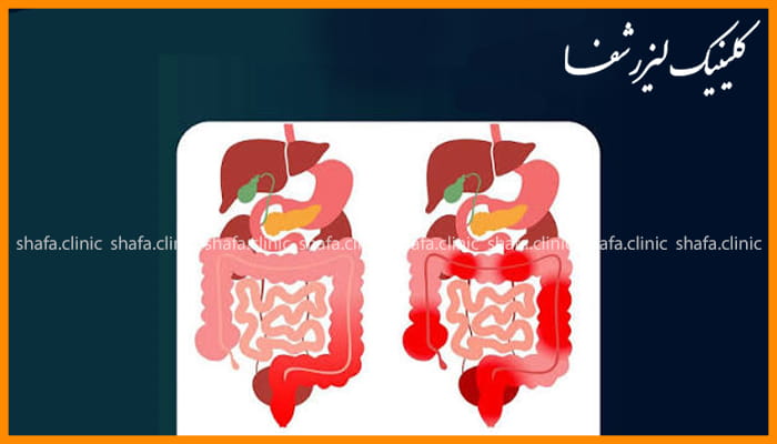 آیا اسلیو دلیل ایجاد بواسیر بعد از عمل اسلیو چیست؟هموروئید می شود؟
