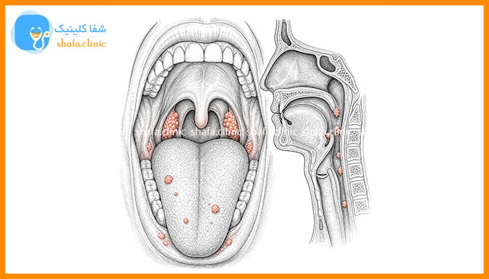 زگیل HPV در دهان چه شکلی است؟ عکس زگیل دهانی